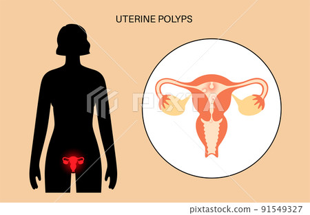 Uterus Polyps Disease Uterus Polyps Disease 91549327