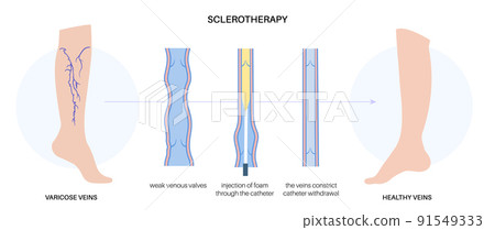 Varicose Injection procedure Varicose Injection procedure 91549333