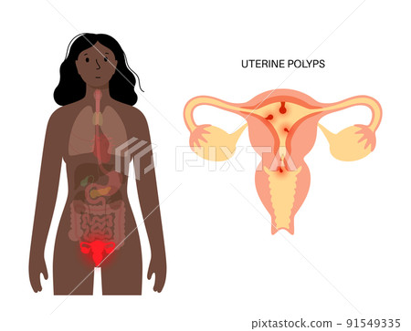 Uterus Polyps Disease Uterus Polyps Disease 91549335