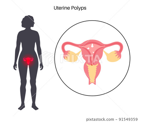 Uterus Polyps Disease 91549359