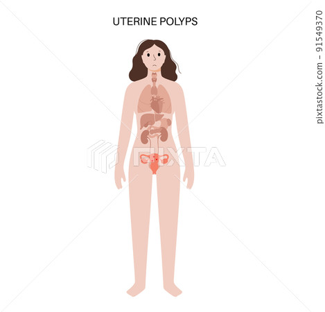Uterus Polyps Disease 91549370
