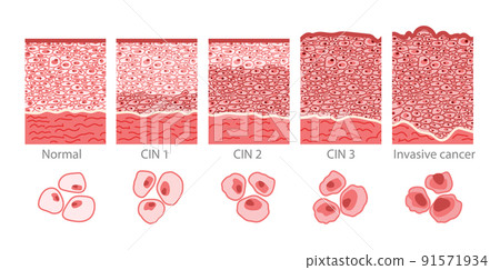 Cervical cancer cells elongated Dysplasia stages infographic Female reproductive system squamous cell carcinoma uterus 91571934