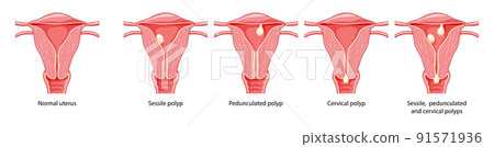 Set of Polyps in the uterus Female reproductive... - Stock Illustration ...