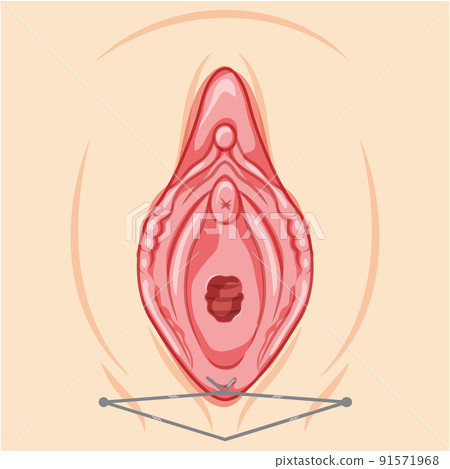 Vaginal lifting with threads Female reproductive system of external genital organs. Front view. Human Surface anatomy 91571968
