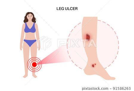 Trophic ulcer anatomy 91586263