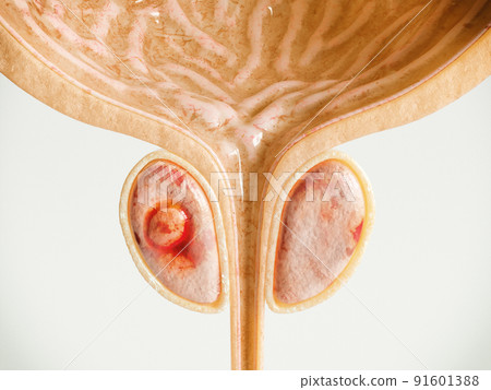 Prostate Cancer Stage 01 of 04 - Detailed High Quality 3D Rendering 91601388