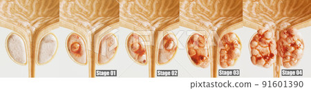 Prostate cancer all 4 stages - detailed close-up - 3D rendering Prostate cancer all 4 stages - detailed close-up - 3D rendering 91601390