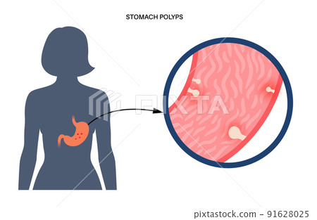 Stomach polyp disease Stomach polyp disease 91628025