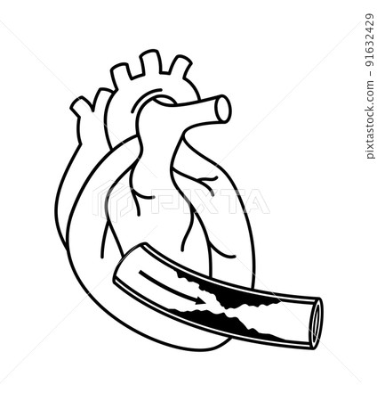 Human heart with Coronary Artery Disease.  91632429