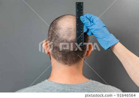 A man with baldness on his head is examined by a trichologist. The doctor's hand measures the bald spot with a ruler. Back view. The concept of alopecia and professional treatment A man with baldness on his head is examined by a trichologist. The doctor's hand measures the bald spot with a ruler. Back view. The concept of alopecia and professional treatment 91646564