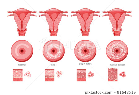 Set of Cervical invasive cancer intraepithelial neoplasia Dysplasia 1 2,3 and normal stage cell morphology on pap smear 91648519