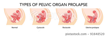 Set of Prolapses types pelvic organ cystocele, uterine, rectocele. Female reproductive system uterus. Human anatomy  91648520