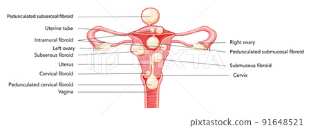 Uterine fibroids Female leiomyomas reproductive system uterus diagram with inscriptions in Latin text. Human anatomy 91648521