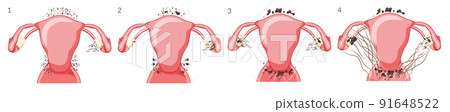 Set of Endometriosis 4 stages Female reproductive system pain cancer cyst uterus. Human anatomy internal organs location 91648522