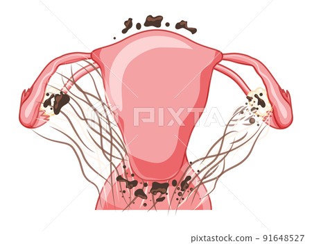 Endometriosis 4 stage Female reproductive system pain pcos tissue cancer cyst uterus. Front view. Human anatomy internal 91648527
