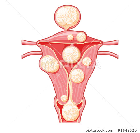 Set of Uterine fibroids Female leiomyomas reproductive system uterus in different styles and cross sections. Front view Set of Uterine fibroids Female leiomyomas reproductive system uterus in different styles and cross sections. Front view 91648529
