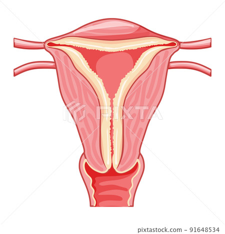Set of Endometrial hyperplasia Female reproductive system uterus with thick endometrium layer. Front view in a cut 91648534