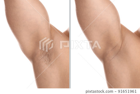 Collage of man showing armpit before and after epilation on white background, closeup Collage of man showing armpit before and after epilation on white background, closeup 91651961