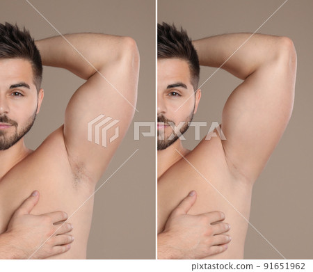 Collage of man showing armpit before and after epilation on light brown background Collage of man showing armpit before and after epilation on light brown background 91651962