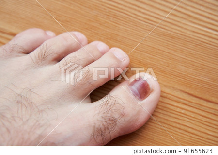 A toe is injured, a heavy object has fallen on the finger. Hematoma under the nail 91655623