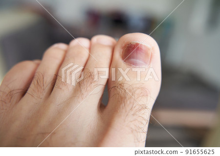 A toe is injured, a heavy object has fallen on the finger. Hematoma under the nail A toe is injured, a heavy object has fallen on the finger. Hematoma under the nail 91655625