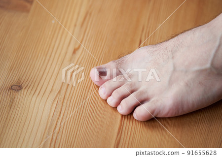 A toe is injured, a heavy object has fallen on the finger. Hematoma under the nail A toe is injured, a heavy object has fallen on the finger. Hematoma under the nail 91655628