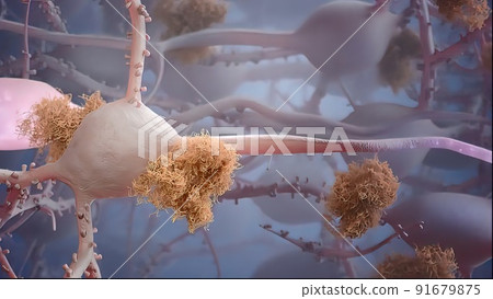 Data loss of neurons Alzheimers Data loss of neurons Alzheimers 91679875
