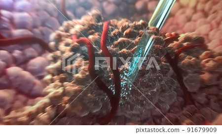Injection defense against tumors illustration Injection defense against tumors illustration 91679909
