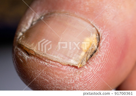 Fungus of nails on the big toe - dermatomycosis and onychomycosis, fungal infection macro photo. Dermatology, treatment of nail mycosis. Fungus of nails on the big toe - dermatomycosis and onychomycosis, fungal infection macro photo. Dermatology, treatment of nail mycosis. 91700361