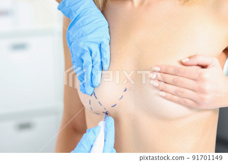 Doctor draws marks on female breast before cosmetic surgery operation Doctor draws marks on female breast before cosmetic surgery operation 91701149