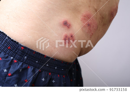 Shingles left thigh Shingles left thigh 91733158