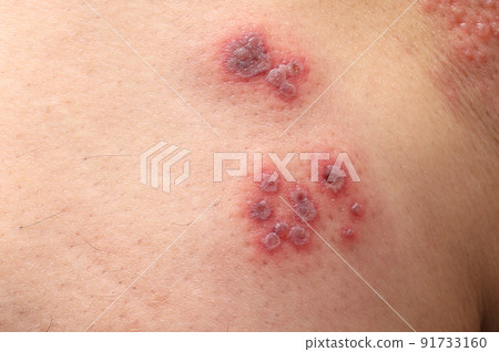 帶狀皰疹左大腿 91733160