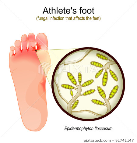 Athlete's foot. fungal infection that affects...-插圖素材 [91741147] - PIXTA圖庫