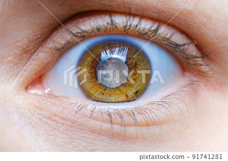 Human eye with clouded lens, white pupil, cataract macro 91741281