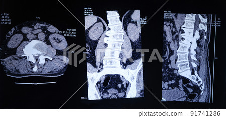 CT image of the spine of a patient with scoliosis and protrusion of the intervertebral disc. 91741286