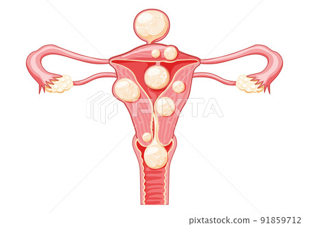 Uterine fibroids Female leiomyomas reproductive system uterus. Front view. Human anatomy medical illustration isolated Uterine fibroids Female leiomyomas reproductive system uterus. Front view. Human anatomy medical illustration isolated 91859712