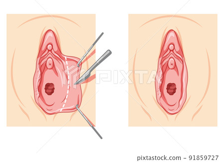 Labiaplasty Female reproductive system process and ready uterus. Vaginoplasty Front view. Human Surface anatomy perineum 91859727