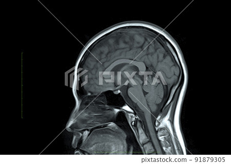 MRI image of the head 91879305