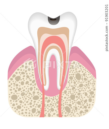 Stage of caries development. Tooth structure in flat style. Tooth decay with enamel. Dental disease realistic vector illustration Stage of caries development. Tooth structure in flat style. Tooth decay with enamel. Dental disease realistic vector illustration 91903201