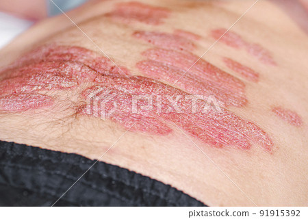 The body of a man is covered with extensive psoriasis. A man lies on his back and on his psoriasis. The body of a man is covered with extensive psoriasis. A man lies on his back and on his psoriasis. 91915392