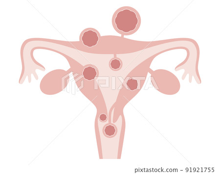 Types of uterine fibroids Types of uterine fibroids 91921755