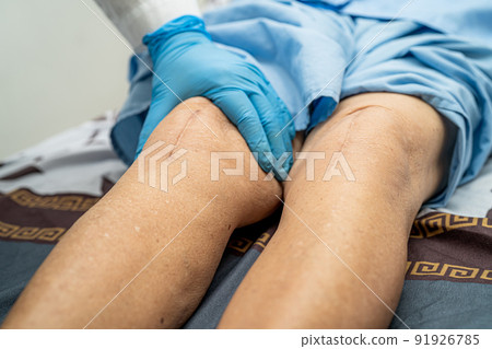 Asian doctor inject Hyaluronic acid platelet rich plasma into the knee of senior woman to walk without pain. 91926785