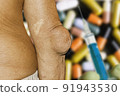 Severe gout in men suffering from joint pain, bone pain, gout, rheumatoid symptoms, radioactive sickness, ill man concept of male osteoporosis, injured bone, injury, pain, arthritis,arm, foot, knee 91943530
