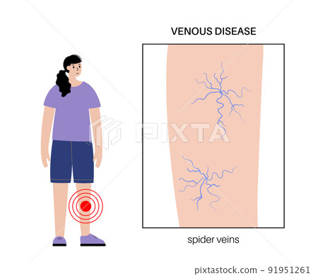 Spider veins treatment Spider veins treatment 91951261