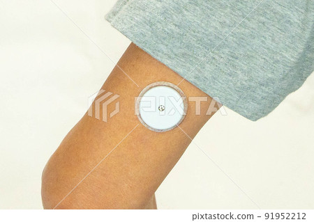 一名男子在上臂後部佩戴血糖監測傳感器 一名男子在上臂後部佩戴血糖監測傳感器 91952212