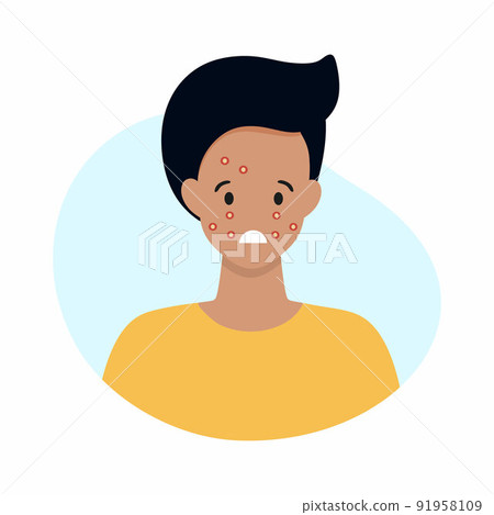 The face of a man with acne on his face. Skin diseases and allergic reactions. Vector illustration for the dermatology clinic. 91958109