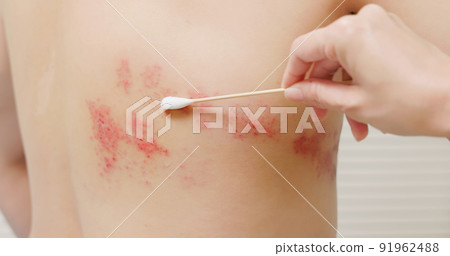 man with shingles disease 91962488