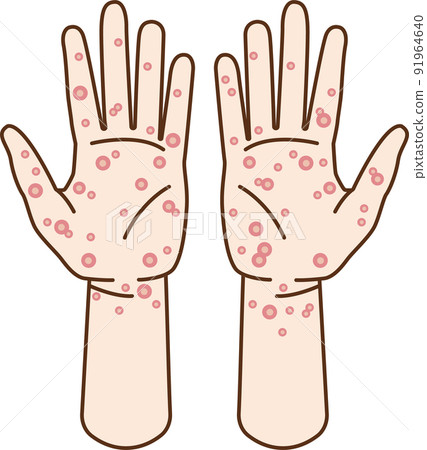 Illustration of hands with syphilis and skin diseases 91964640