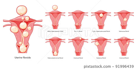 Set of Uterine fibroids Female leiomyomas reproductive system uterus. Front view in a cut. Human anatomy medical Set of Uterine fibroids Female leiomyomas reproductive system uterus. Front view in a cut. Human anatomy medical 91996439