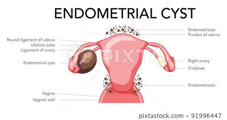 Set of Ovarian endometriomas chocolate cysts Female reproductive system uterus problem diagram with inscriptions Set of Ovarian endometriomas chocolate cysts Female reproductive system uterus problem diagram with inscriptions 91996447